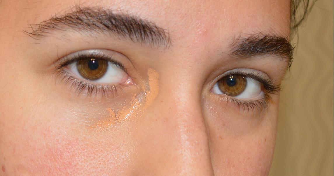 Yellow Discoloration Around The Eyes | Hairsstyles.co
